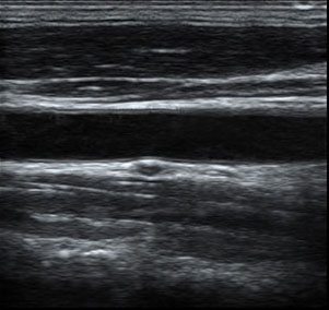 Auto IMT function ultrasound images
